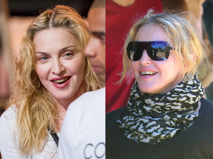 Что случилось с зубами Мадонны 
