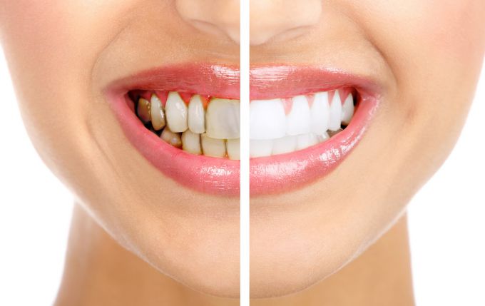 Что такое зубной налет и чем он опасен