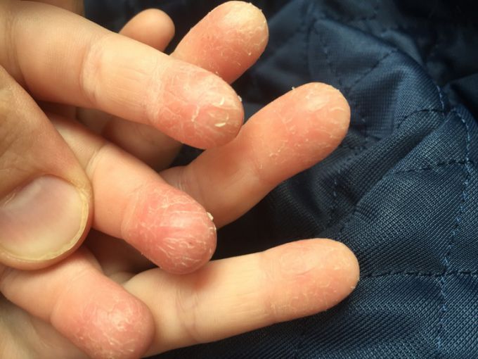 Почему трескается кожа на пальцах рук