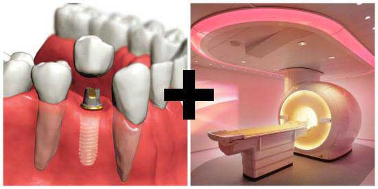 Можно ли делать МРТ с имплантами зубов