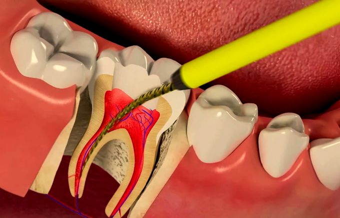 Должен ли болеть зуб после лечения каналов