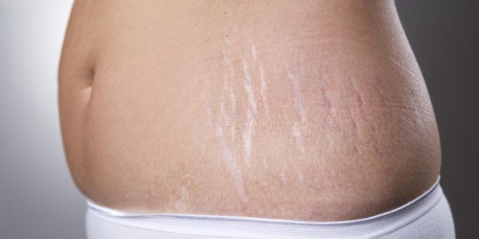 Как избавиться от растяжек, которые появляются на теле во время беременности