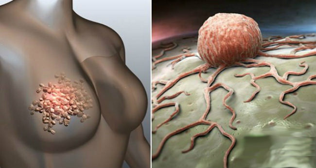графическое изображение опухоли в молочной железе и злокачественной клетки