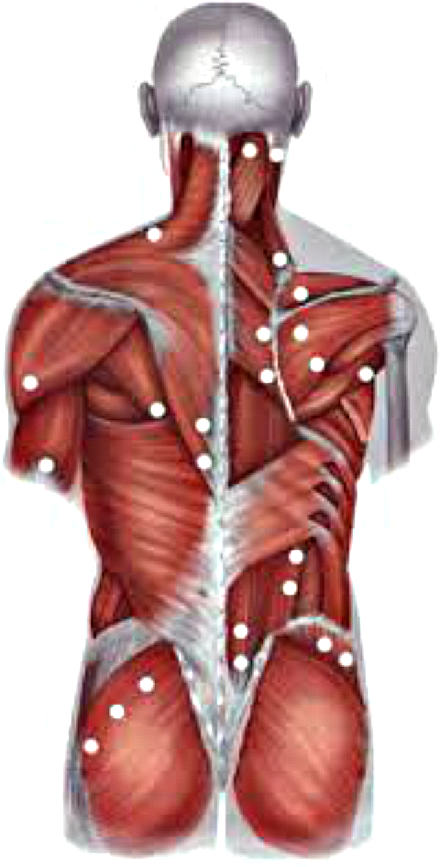 Лимфоузел в мышце. Миофасциальный синдром триггерные точки спины. Длиннейшая мышца спины триггерные точки. Триггерные точки в мышцах спины. Миофасциальный болевой синдром спины.