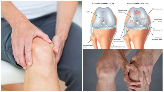 Как вылечить артроз коленного сустава в домашних условиях