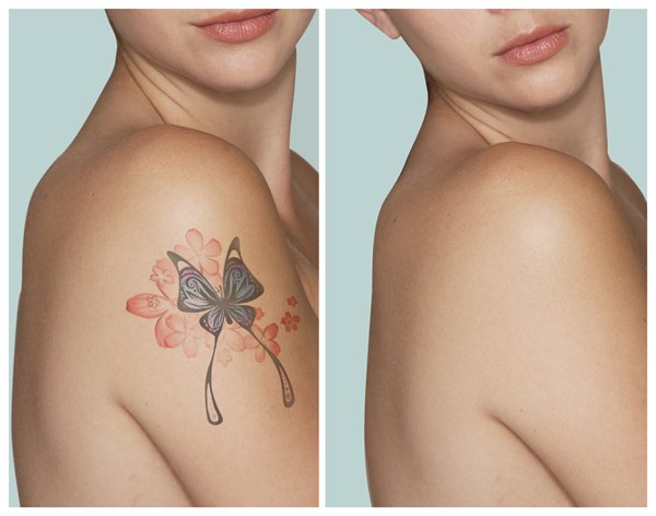 Цветная татуировка до и после проведения процедуры